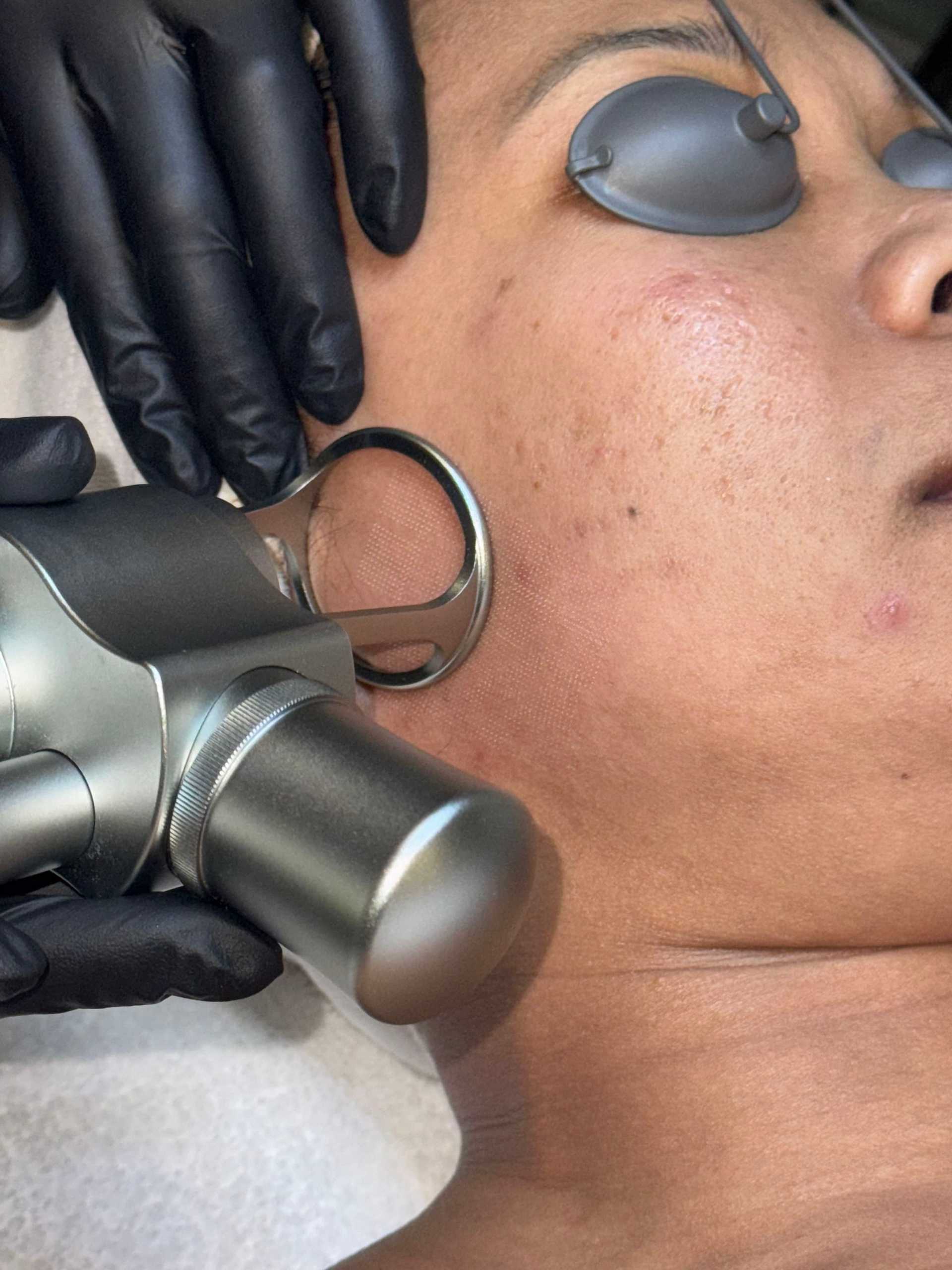 Person undergoing laser skin treatment with protective eyewear. Black-gloved hands hold the device.