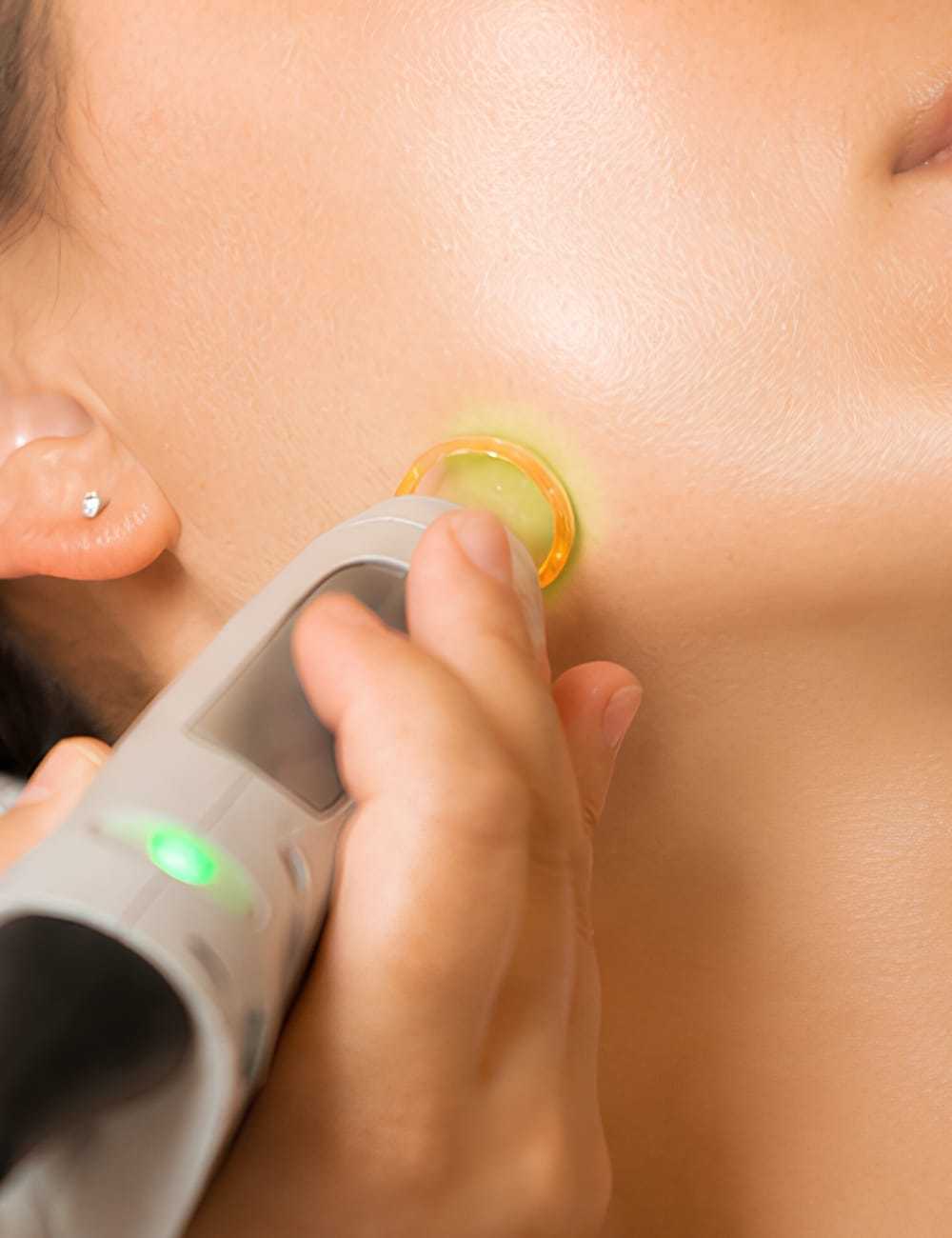 Hand using laser device on person's cheek for skincare treatment.