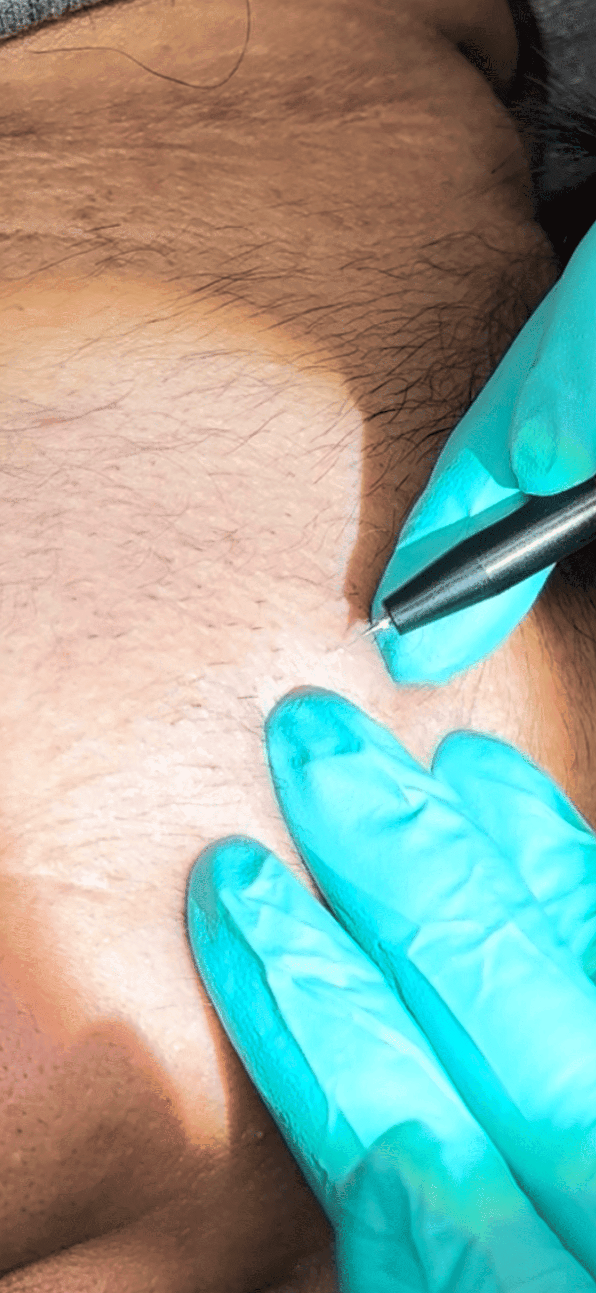 Removing blackhead with extractor on skin, close-up view.